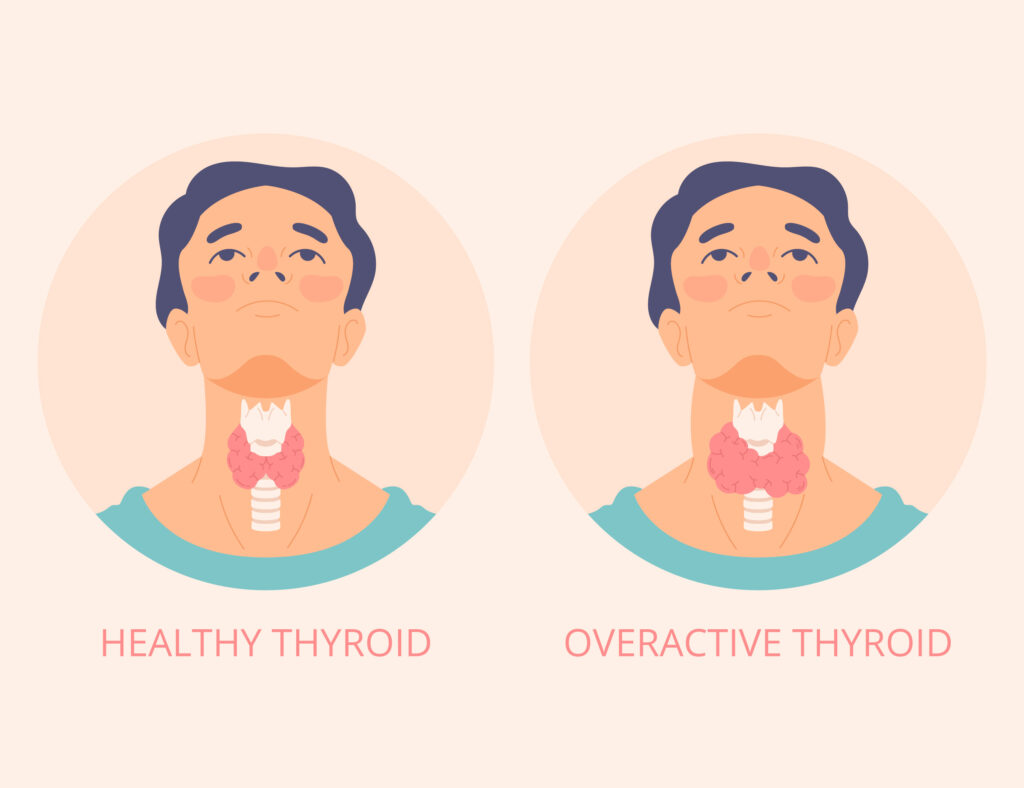 Thyroid Disorders and Weight Loss: Can You Lose Weight with Hypothyroidism?